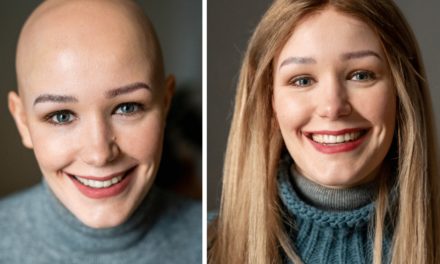Ein Leben ohne Haare: Anjoula klärt über ihre Erkrankung Alopecia auf